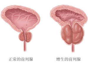 上海男人正常前列腺大小是多少