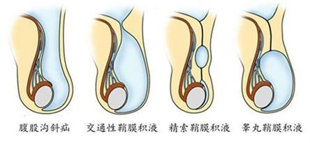 阴囊里有无痛性肿块为什么