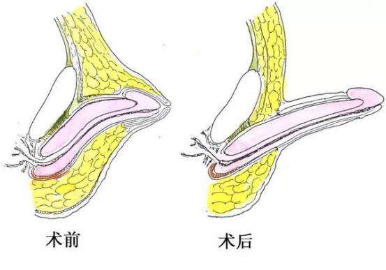 上海男人阴茎短小该怎么办
