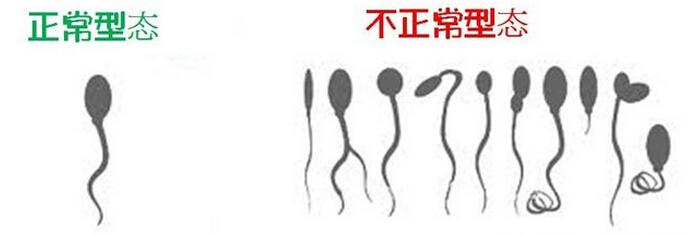 男性为何会出现精子畸形