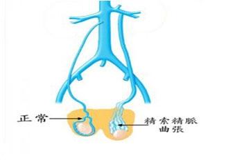 精索静脉曲张治疗后会复发吗