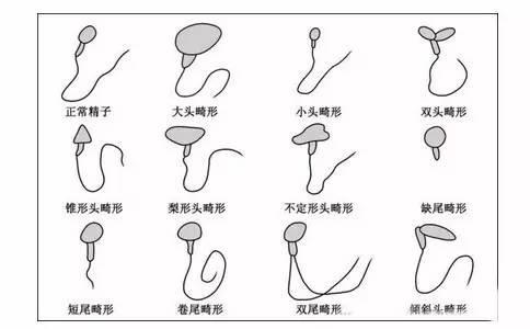 精子有畸形该怎么办