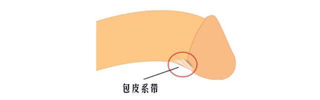 男性为什么会出现包皮系带过短