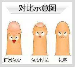 包皮里总有豆腐渣一样的东西为什么