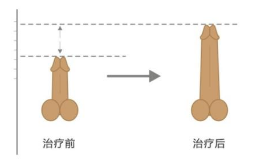 上海做阴茎*术去什么医院好