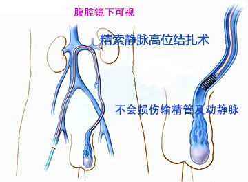 得了精索曲张要怎么治疗