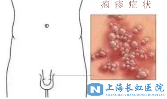 男性感染上生殖疱疹会有什么症状