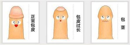 做包茎手术大概要多少钱