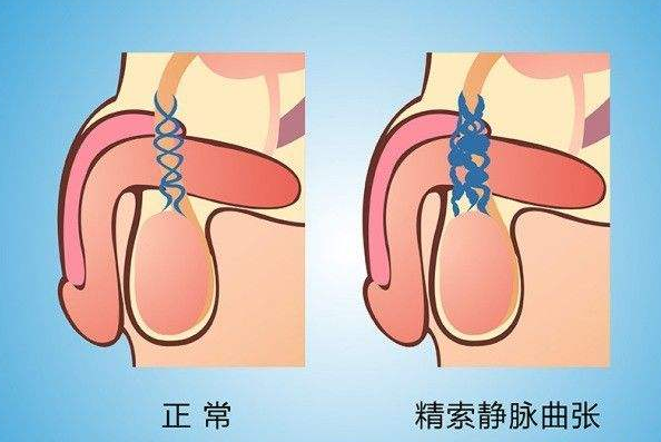睾丸部位血管呈蚯蚓状怎么回事