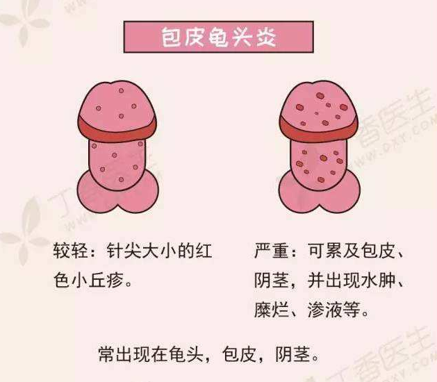 龟头炎的症状图片