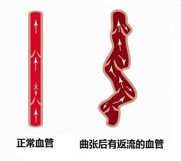 【上海男科】精索曲张怎么治疗好