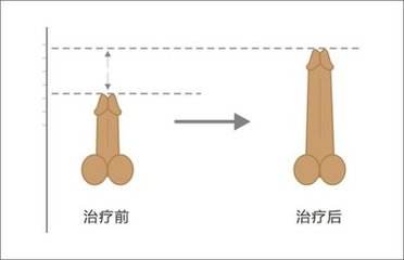 阴茎长短会影响性能力吗?治疗的话需要多少钱