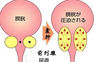 男人得了前列腺肿块会造成什么后果呢