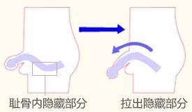 阴茎*手术有风险吗?什么情况下才能进行手术
