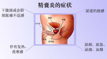 精囊炎有什么症状?该怎么护理呢?