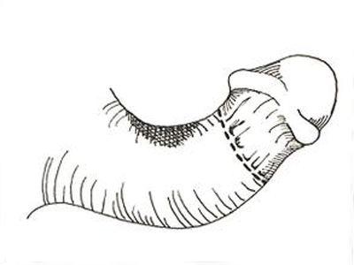 上海长虹医院:生殖器畸形危害男性身心健康!